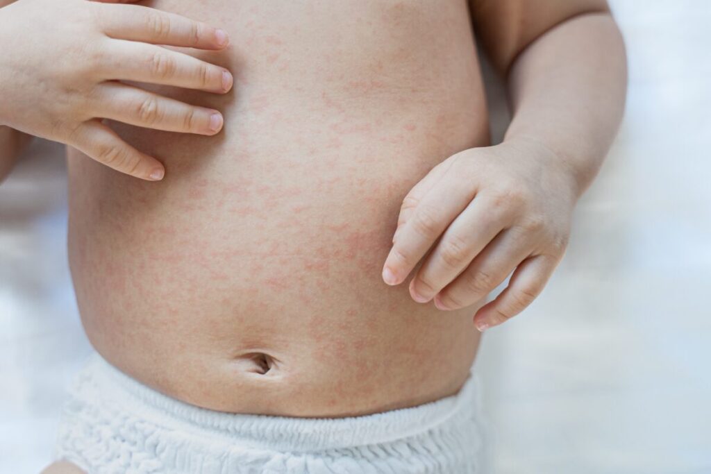 vodene kozice kod djece